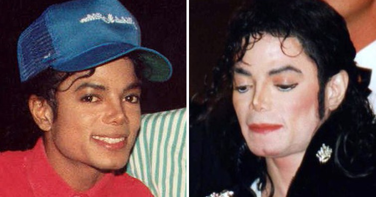 マイケル・ジャクソンの肌が年々白くなっていった理由とは？